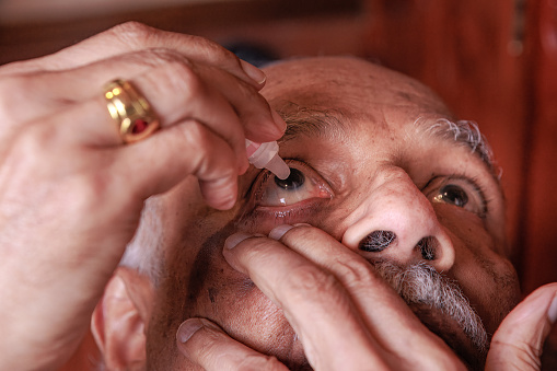 This 76-year-old Asian Indian man has an eye stye in the lower eyelid of his right eye. He is seen applying eye drops for the ailment. Focus on the eye – studio shot.