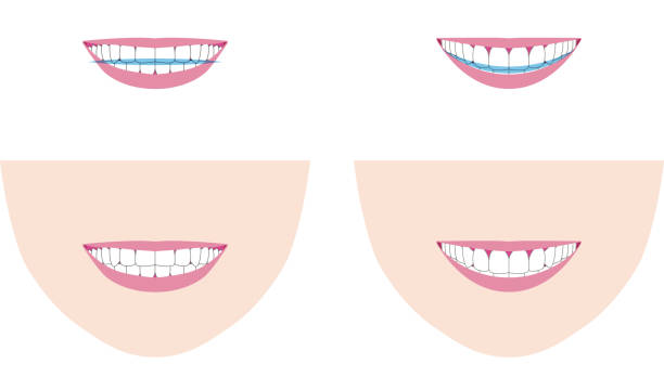 ilustrações, clipart, desenhos animados e ícones de ilustração vetorial de como a fileira de dentes parece em um sorriso. curva de linha do sorriso e linha reta - makeover series