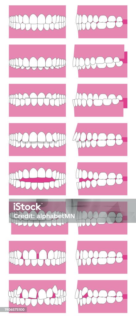 Tooth Allignment Types Of Tooth Alignment And Malocclusion Front And Side Vector ...