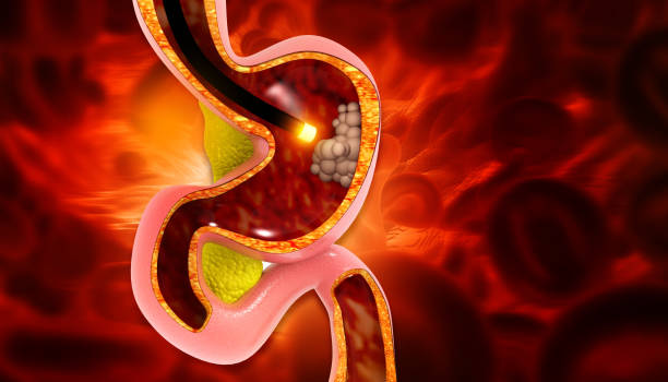 istock Stomach cancer, Cancer attacking cell, Endoscopy, 3d illustration 1907001063