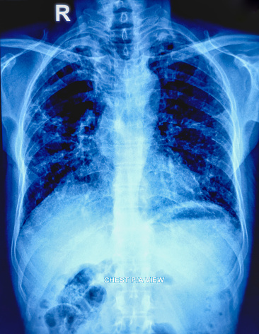 X-ray of the human chest. Bilateral apical pleural thickening. Unfolded or tortuous aorta. A bilateral extensive pulmonary inflammatory lesion with multifocal patchy consolidation with emphysematous change.