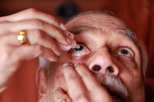 This 76-year-old Asian Indian man has an eye stye in the lower eyelid of his right eye. He is seen applying eye drops for the ailment. Focus on the eye  studio shot.