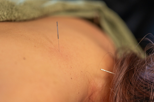 A therapist gives acupuncture to another woman in a Japanese domestic room.