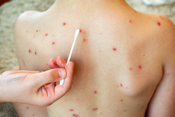 natural vaccination. contagious disease. - chickenpox skin condition baby illness foto e immagini stock