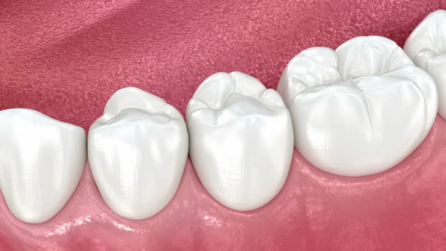 Inlay ceramic crown placement. Medically accurate 3D animation