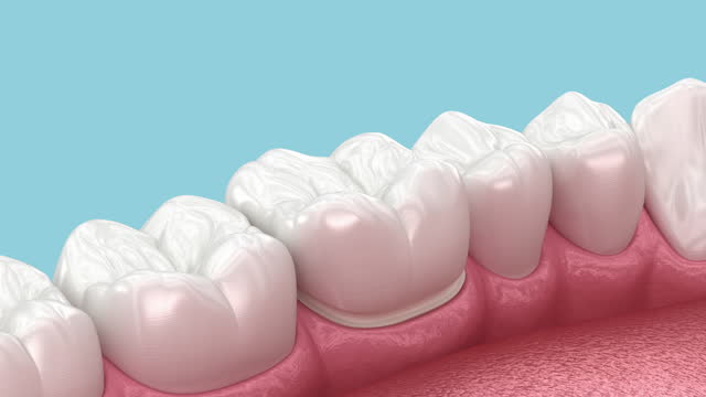 Preparated molar tooth and dental crown placement. Dental 3D animation