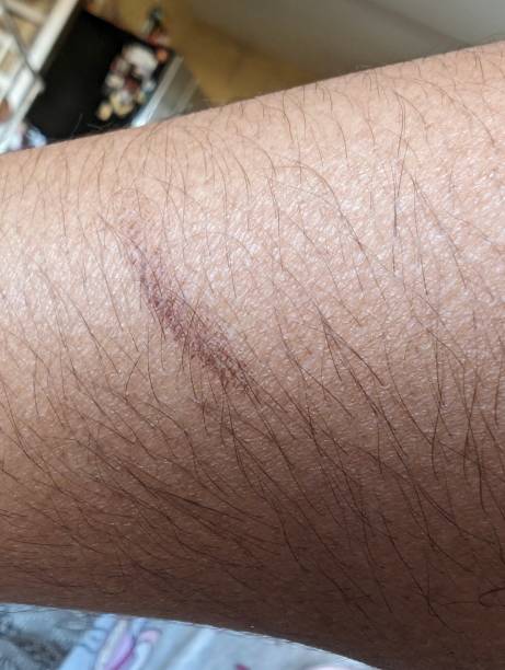 istock Burn scar on skin 1912903912