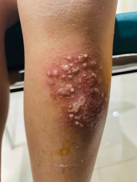 istock Viral infection in the skin called by herpes simplex 1914737625