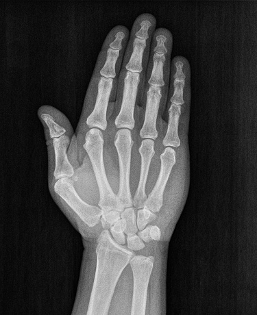 Film xray x-ray or radiograph of a hand and fingers showing ban, stop, halt, forbidden, no trespassing in gestural language, manual communication, or signing aka sign language