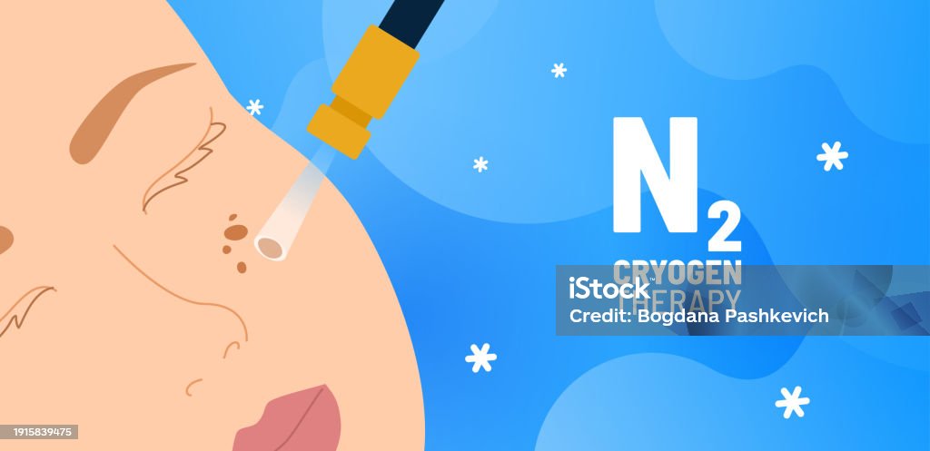 Cryotherapy Process Cryotherapy Process Vector Illustration Removing Age Spots On Womans ...