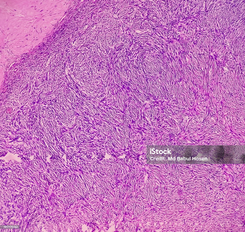 Inflamatory Cell Image Uterus With Adnexa Cervix Show Chronic Inflamatory Cells Wall Show ...