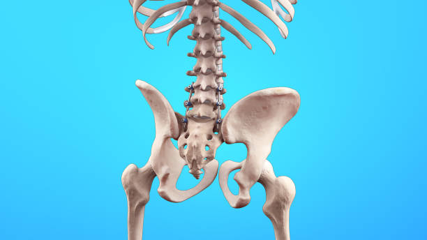 spine posterior lumbar fusion with pedicle screws and rods - thoracic vertebrae lumbar vertebra cervical vertebrae sacrum foto e immagini stock