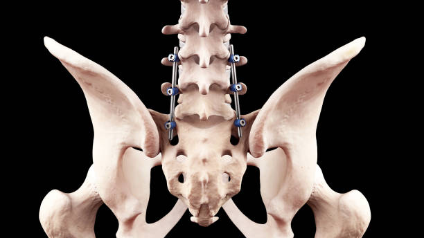 spine posterior lumbar fusion with pedicle screws and rods - thoracic vertebrae lumbar vertebra cervical vertebrae sacrum foto e immagini stock