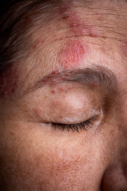 Hispanic mature woman with Herpes Zoster infection on the right hand side of face and eye Health issues theme: Hispanic mature woman with Herpes Zoster infection on the right hand side of face and eye shingles rash stock pictures, royalty-free photos & images