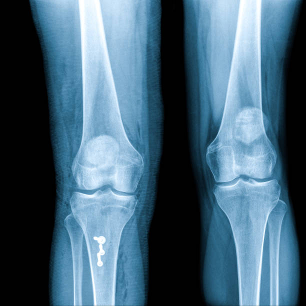 istock X-ray Knee Joint Fracture proximal tibia and Post fix fracture proximal tibia with plate and screws.Normal joint space.Minimal joint effusion 1918788176
