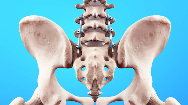 spine posterior lumbar fusion with pedicle screws and rods - thoracic vertebrae lumbar vertebra cervical vertebrae sacrum foto e immagini stock