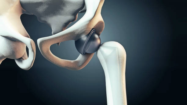 Hip replacement. Xray of Hip Replacement,Medicine, medical and healthcare, surgery, science concepts. hip replacement stock pictures, royalty-free photos & images