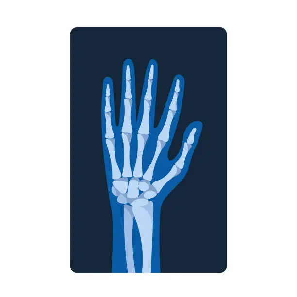 Vector illustration of X-ray Pictures Of The Hand Reveal Internal Bone Structures, Joints, And Abnormalities, Aiding In Diagnosing Fractures