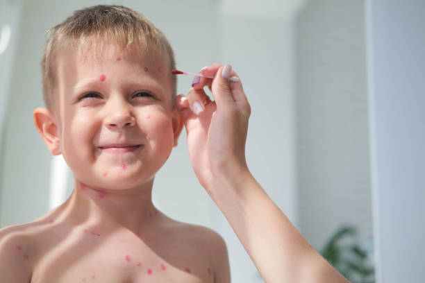 treatment of ulcers from chickenpox, chickenpox with a healing cream on the skin of a child. mom treats the child's face with red medicine. - chickenpox skin condition baby illness stock-fotos und bilder