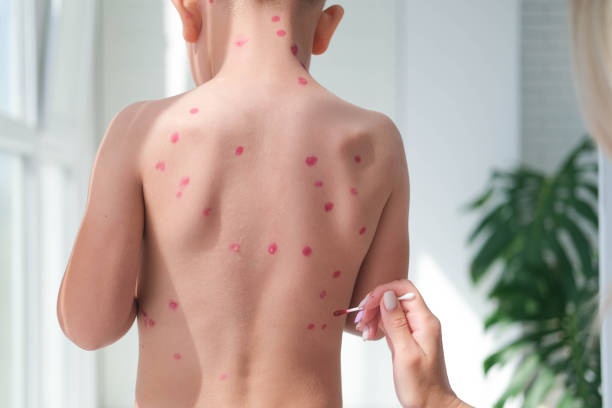 treatment of ulcers from chickenpox, varicella with medical cream on the kid skin. mom treats the child's back with red medicine. - chickenpox skin condition baby illness stock-fotos und bilder