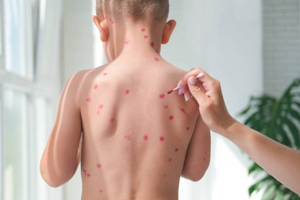 treatment of ulcers from chickenpox, varicella with medical cream on the kid skin. mom treats the child's back with red medicine. - chickenpox skin condition baby illness stock-fotos und bilder