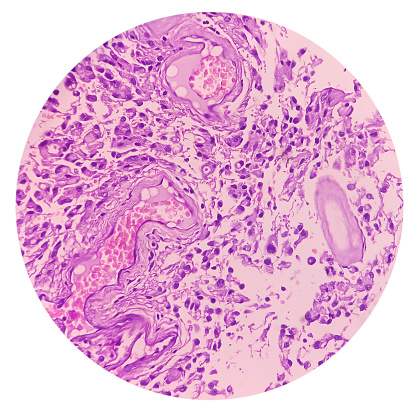 Astrocytoma, Intramedullary SOL (C5-D3) tissue biopsy. Photomicrograph show malignant neoplasm of oval to elongated cells with eccentric cuclei and eosinophilic cytology. Micovascular proliferation.