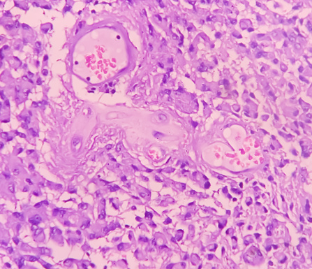 Astrocytoma, Intramedullary SOL (C5-D3) tissue biopsy. Photomicrograph show malignant neoplasm of oval to elongated cells with eccentric cuclei and eosinophilic cytology. Micovascular proliferation.