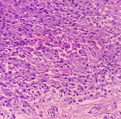 Astrocytoma, Intramedullary SOL (C5-D3) tissue biopsy. Photomicrograph show malignant neoplasm of oval to elongated cells with eccentric cuclei and eosinophilic cytology. Micovascular proliferation.