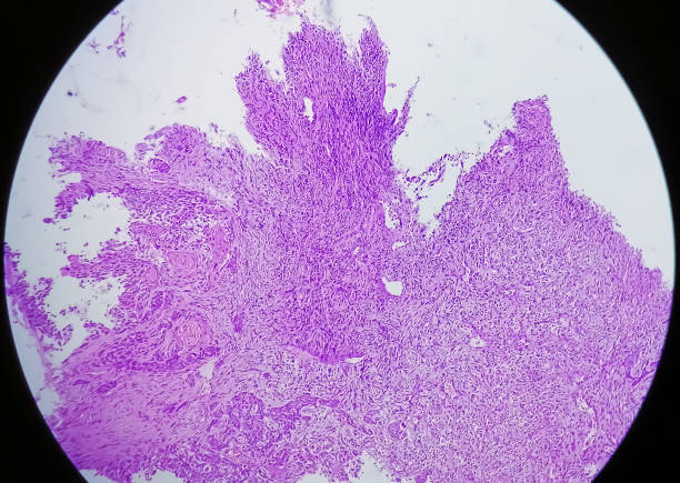 istock Invasive squamous cell carcinoma of larynx, grade II 1919712100