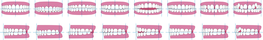 Types Of Tooth Alignment And Malocclusion Front And Side Vector types-of-tooth-alignment-and-malocclusion-front-and-side-vector
