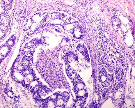 Light microscopic micrograph of a prostate cancer (adenocarcinoma). The prostate cancer cells form glandular structures. This type of pattern gland pattern is known as cribriform. The glands are interspersed within the prostatic stroma. Haematoxylin-eosin.