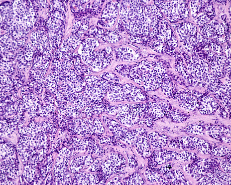 Hepatocellular carcinoma (HCC or HCC) is the most common malignant tumour originating in the liver and is one of the leading causes of cancer-related death worldwide. It most commonly develops in people who suffer from chronic liver diseases, such as cirrhosis caused by hepatitis B or C. Tumour cells form trabeculae, cords, and nests separated by connective tissue septa