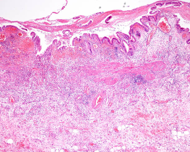 istock Gangrenous cholecystitis 1922209819