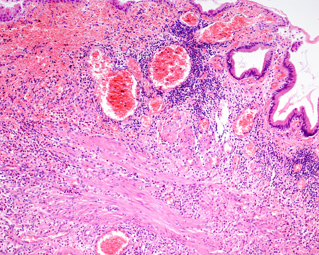 Cholecystitis is inflammation of the gallbladder. Gangrenous or necrotizing cholecystitis is a severe advanced form of acute cholecystitis and the most common complication. The micrograph shows a thickened gallbladder wall with severe inflammation and necrosis. Gallbladder epithelium is on top.
