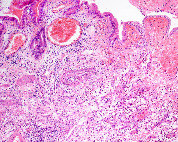 istock Gangrenous cholecystitis 1922210366