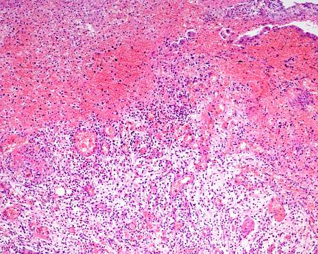 Cholecystitis is inflammation of the gallbladder. Gangrenous or necrotizing cholecystitis is a severe advanced form of acute cholecystitis and the most common complication. The micrograph shows a thickened gallbladder wall with severe inflammation and necrosis. Gallbladder epithelium is on top.