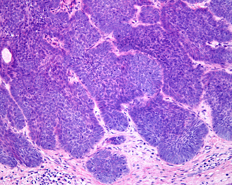Light microscope micrograph of human skin showing an ulcerated basal cell carcinoma (BCC). The intense proliferative activity of epidermal basal keratinocytes forms lobular structures that invade the dermis.