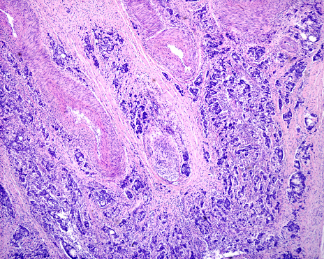 Light micrograph of prostatic cancer (adenocarcinoma). The cancerous cells form solid sheets of cells without forming glands. This is considered a high-grade type of pattern that carries a worse prognosis. Haematoxylin and eosin.