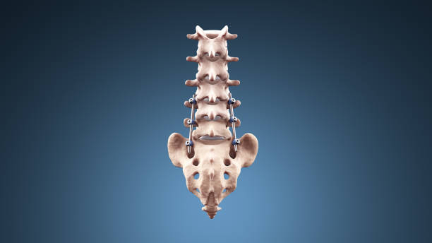 fusione lombare posteriore della colonna vertebrale con viti e aste peduncolari - thoracic vertebrae lumbar vertebra cervical vertebrae sacrum foto e immagini stock