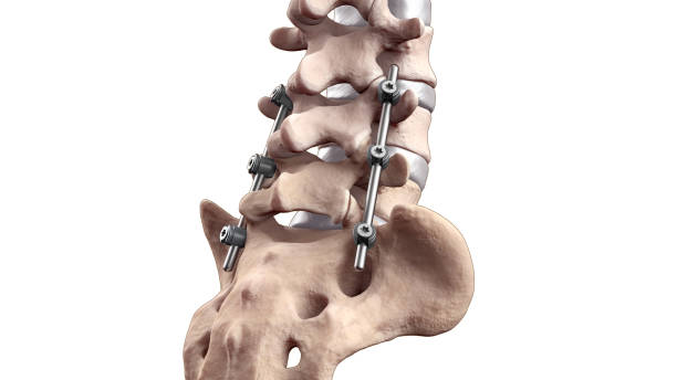 fusione lombare posteriore della colonna vertebrale con viti e aste peduncolari - thoracic vertebrae lumbar vertebra cervical vertebrae sacrum foto e immagini stock