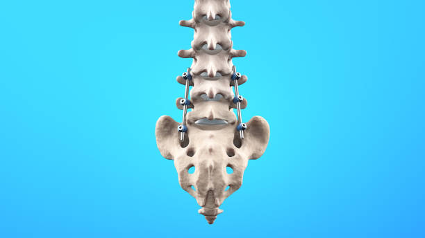 fusione lombare posteriore della colonna vertebrale con viti e aste peduncolari - thoracic vertebrae lumbar vertebra cervical vertebrae sacrum foto e immagini stock