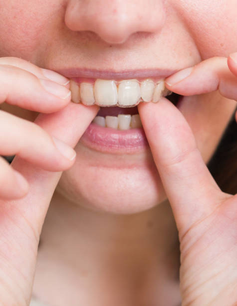 istock mouth wearing an invisible orthodontic dental aligner 1923276443