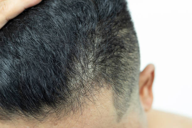 istock Close Up Young people have problems with hair loss, dryness, dullness, split ends and damage. 1923321735