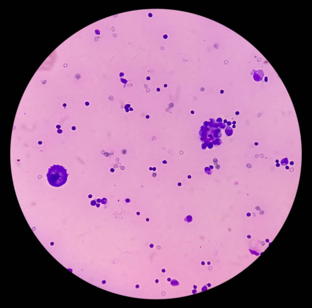 istock Ascitic fluid cytology. Leishman stain smear show Lymphocytes, polymorphs cells. 1923660218