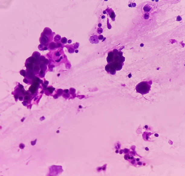 istock Ascitic fluid cancer. Metastatic adenocarcinoma. 1923859945