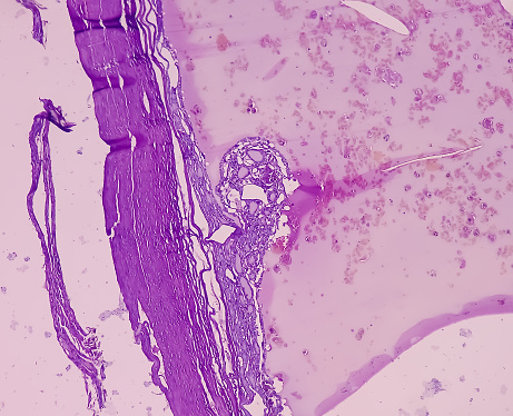 Thyroid cancer, Papillary thyroid microcarcinoma with nodular colloid goitre. Atypical thyroid follicular cells show nuclear clearing. Extensive fibrosis.