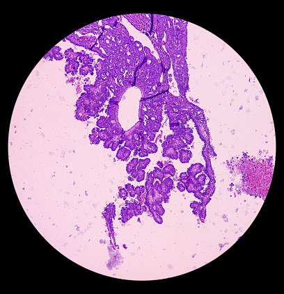 Thyroid cancer, Papillary thyroid microcarcinoma with nodular colloid goitre. Atypical thyroid follicular cells show nuclear clearing. Extensive fibrosis.