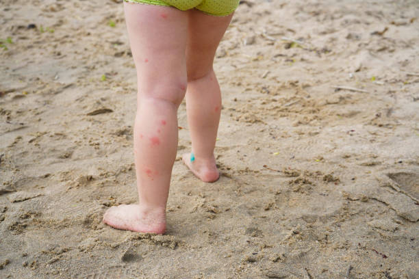 close-up of children's bare feet, a child walking on the sand. acne, mosquito bites, allergies. - mosquito child bug bite scratching imagens e fotografias de stock