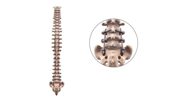 spine posterior lumbar fusion with pedicle screws and rods - thoracic vertebrae lumbar vertebra cervical vertebrae sacrum foto e immagini stock