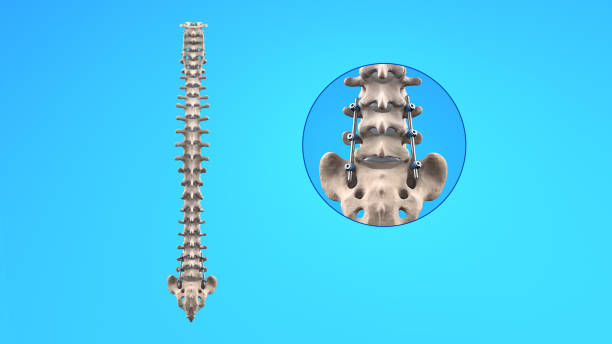 spine posterior lumbar fusion with pedicle screws and rods - thoracic vertebrae lumbar vertebra cervical vertebrae sacrum foto e immagini stock